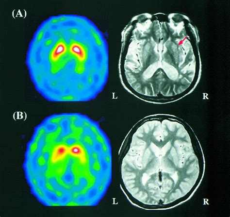 nuclear brain scan for parkinson's
